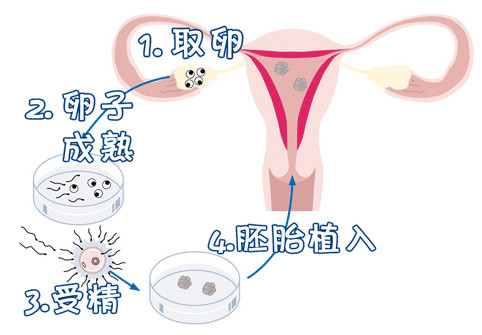 高龄二胎成功案例